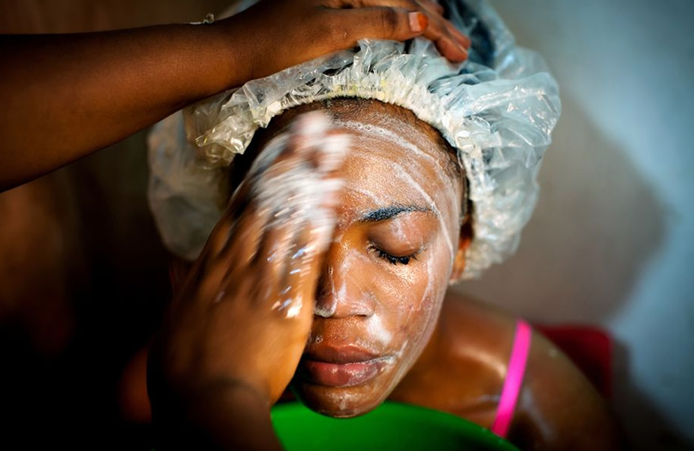 Skin Lightening in Uganda